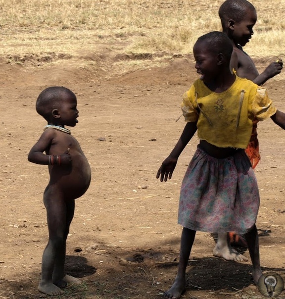 ИЗ-ЗА ЧЕГО У АФРИКАНСКИХ ДЕТЕЙ ВЫРАСТАЕТ ТАКОЙ БОЛЬШОЙ ЖИВОТ На многих фотографиях, где запечатлены жители бедных африканских деревень можно увидеть грязных полуголых детей в порванной одежде.