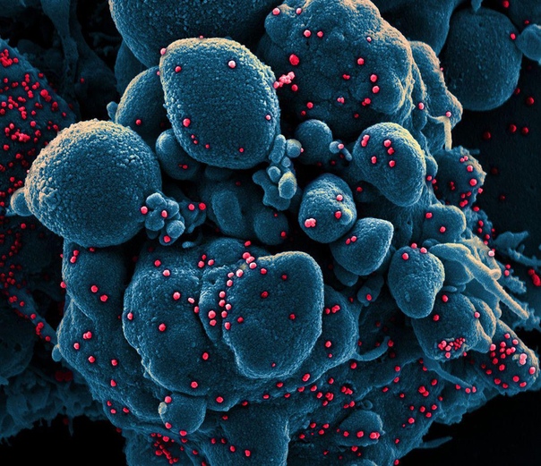 На фото вы видите окрашенную электронную микрографию инфицированной новым вирусом SARS-CoV-2 клетку, выделенную из пациента